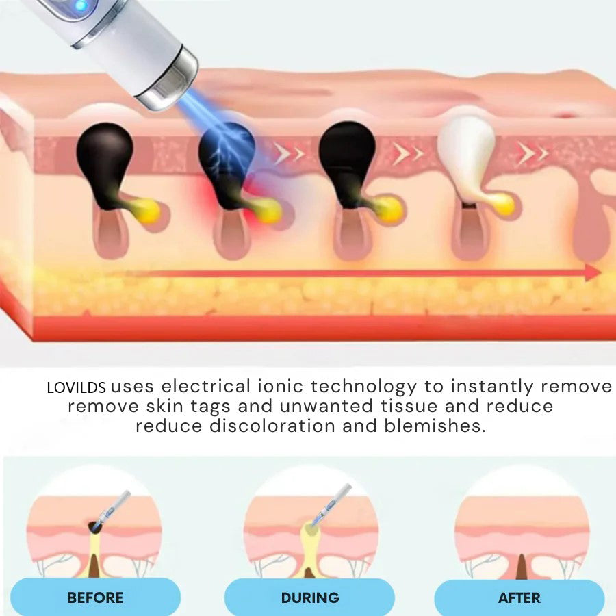 š„ćOFFICIAL STOREć Non-Invasive Mole and Wart Removal Laser Pen