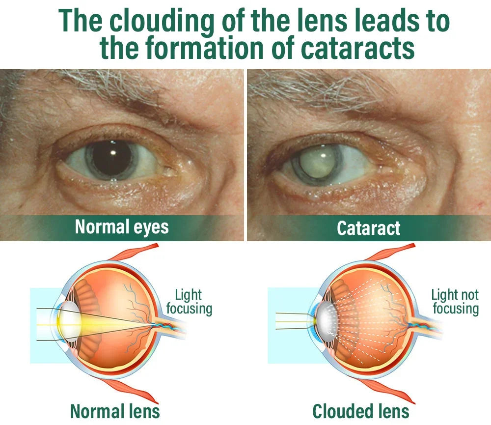 Nano Vision Repair Eye Serum ✅FDA Approved(Suitable for presbyopia, dry eye syndrome, glaucoma, and cataracts)