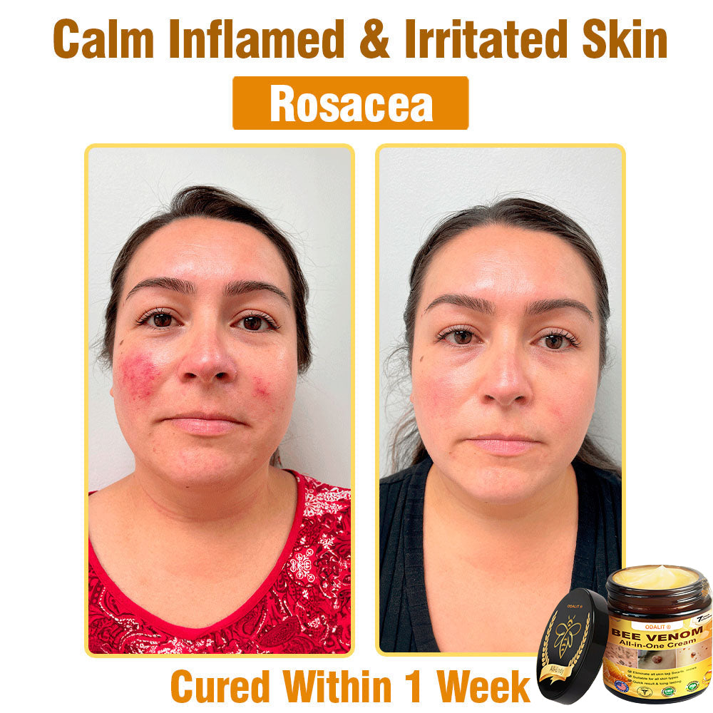 ODALIT™ Bee Poison All-in-One Cream US Dermatologist Approved