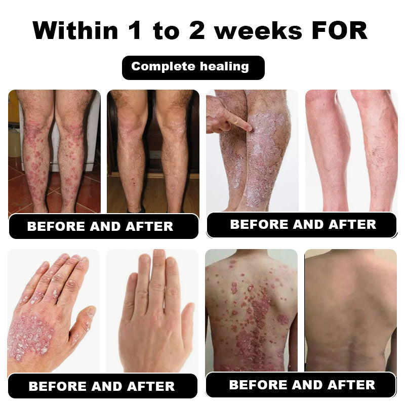 Psoriasis Cure Cream, relieves itching and restores smooth and youthful skin
