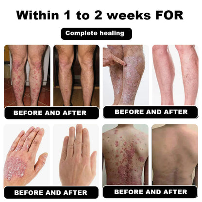 Psoriasis Cure Cream, relieves itching and restores smooth and youthful skin