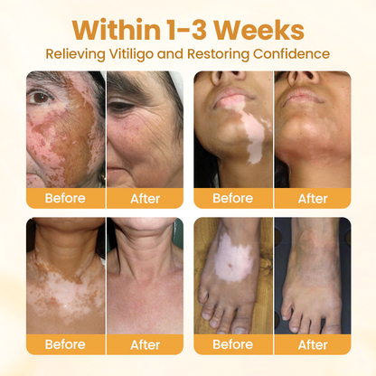Final 3 Hours:50% OFF🔥【Official Flagship Store】 VitiClear Pro Bee Toxin Cream