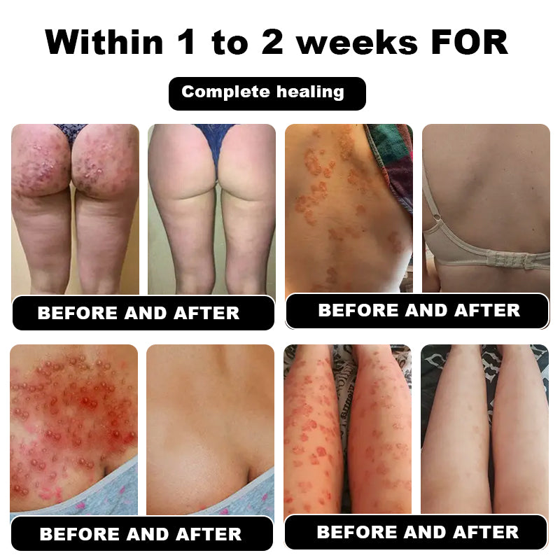 Psoriasis Cure Cream, relieves itching and restores smooth and youthful skin