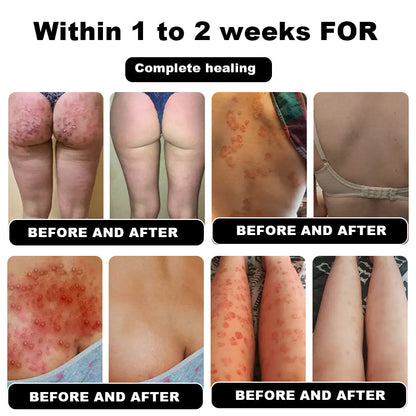 Psoriasis Cure Cream, relieves itching and restores smooth and youthful skin