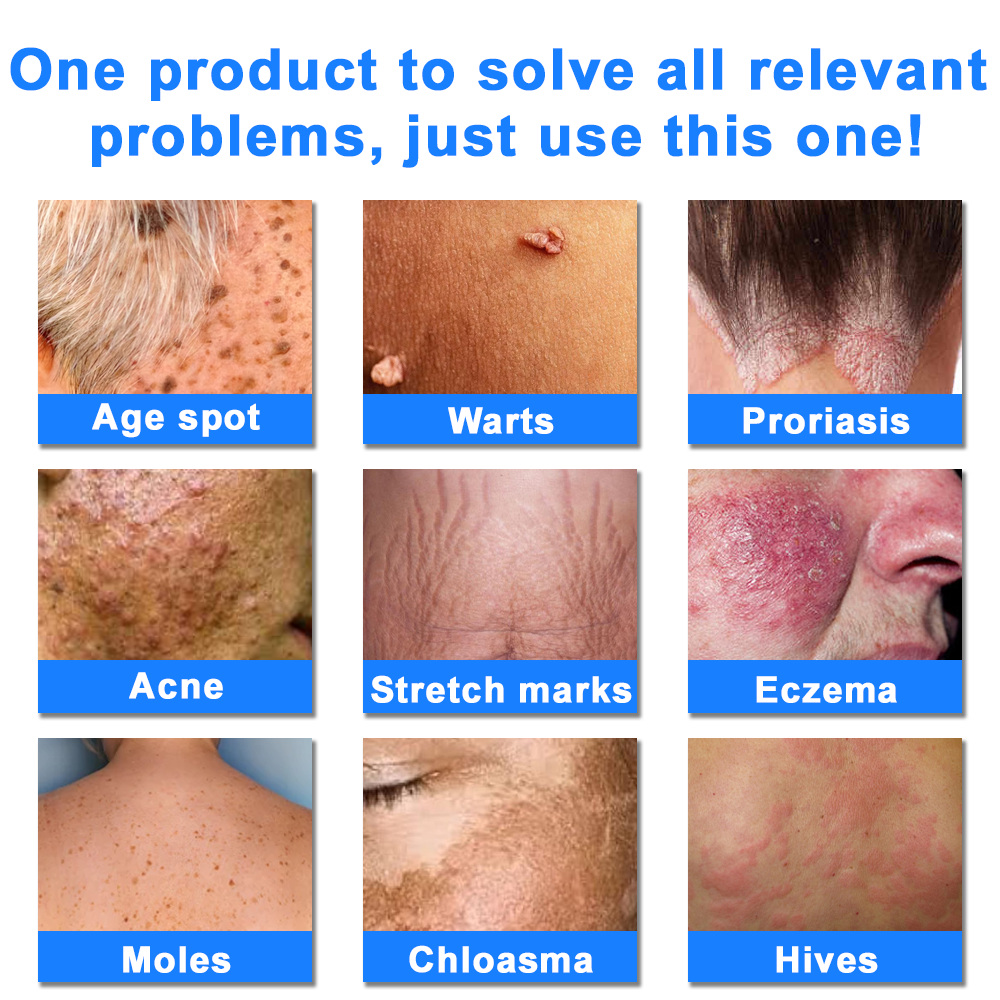 ✅NHS Approved: ODEIUN™ Skin Treatment Cream(Relieves eczema, dermatitis, psoriasis, skin allergies,  pigmentation, dry skin, and other common skin issues)