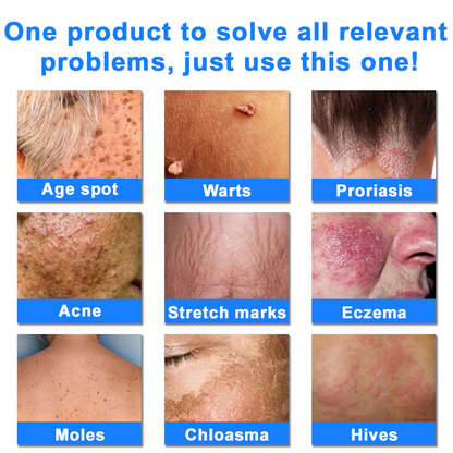 ✅NHS Approved: ODEIUN™ Skin Treatment Cream(Relieves eczema, dermatitis, psoriasis, skin allergies,  pigmentation, dry skin, and other common skin issues)