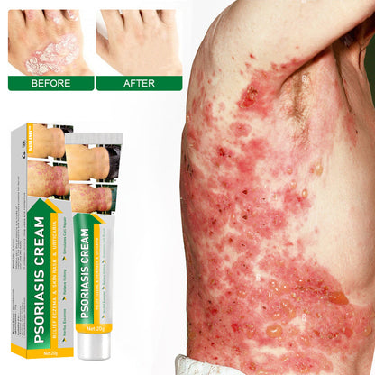 Psoriasis Cure Cream, relieves itching and restores smooth and youthful skin