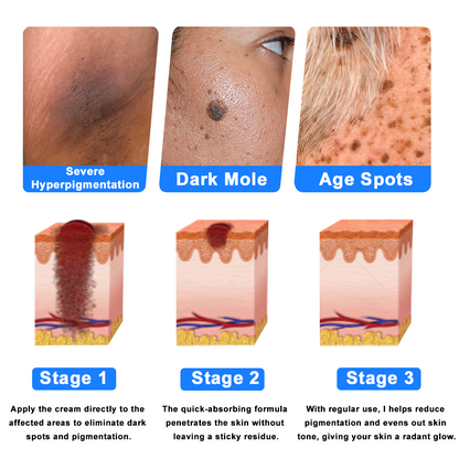 ✅NHS Approved: ODEIUN™ Skin Treatment Cream(Relieves eczema, dermatitis, psoriasis, skin allergies,  pigmentation, dry skin, and other common skin issues)