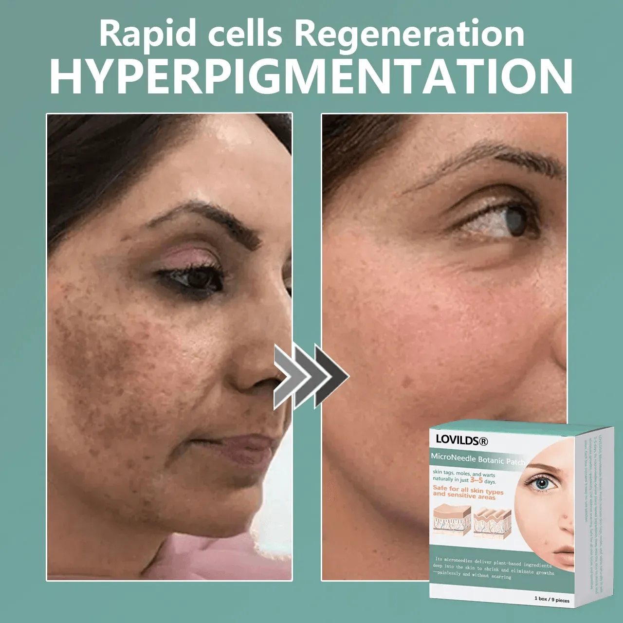 🔥Final 3 Hours -  Magnesium MicroNeedle Quick Remove Skin Tag Patches