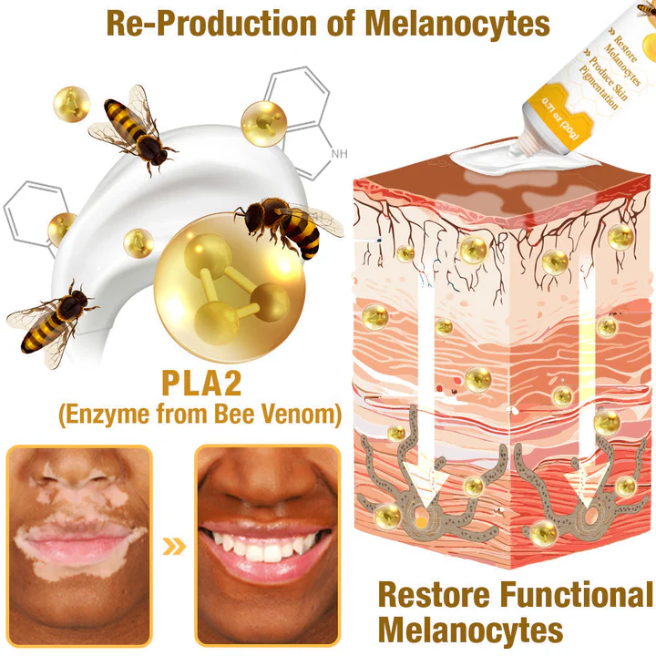 【Official Flagship Store】 Bee Venom Vitiligo Treatment Cream