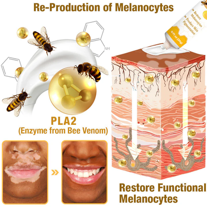 【Official Flagship Store】 Bee Venom Vitiligo Treatment Cream