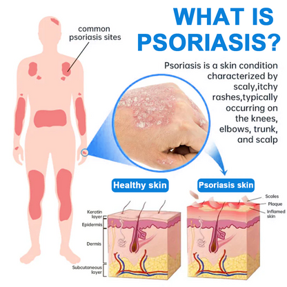 ✅ Official Store: Magnesium Herbal Psoriasis Spray ⚕️