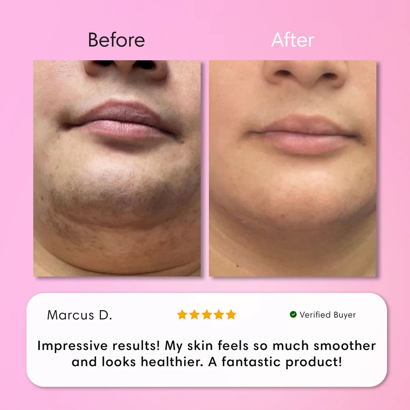 JEREMYTIS™ Instant Hair Removal Kit