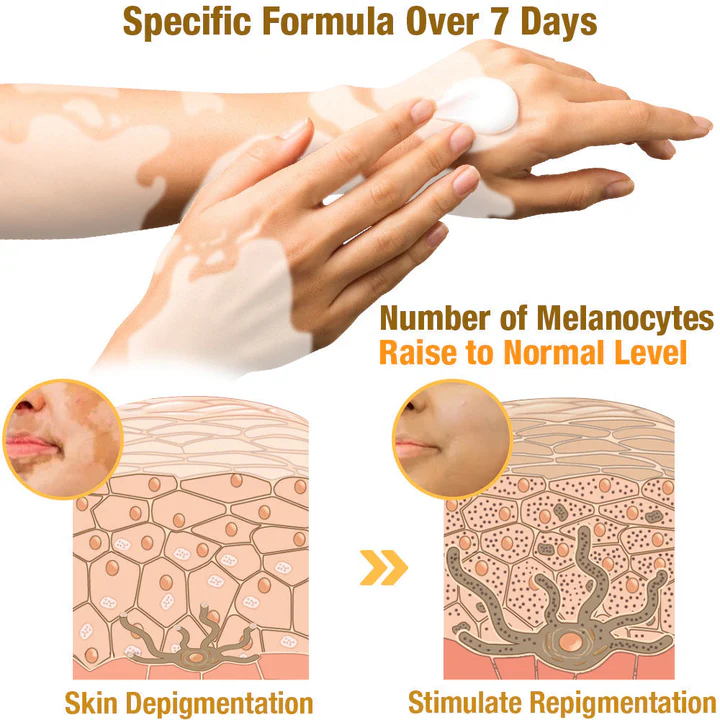 【Official Flagship Store】 Bee Venom Vitiligo Treatment Cream