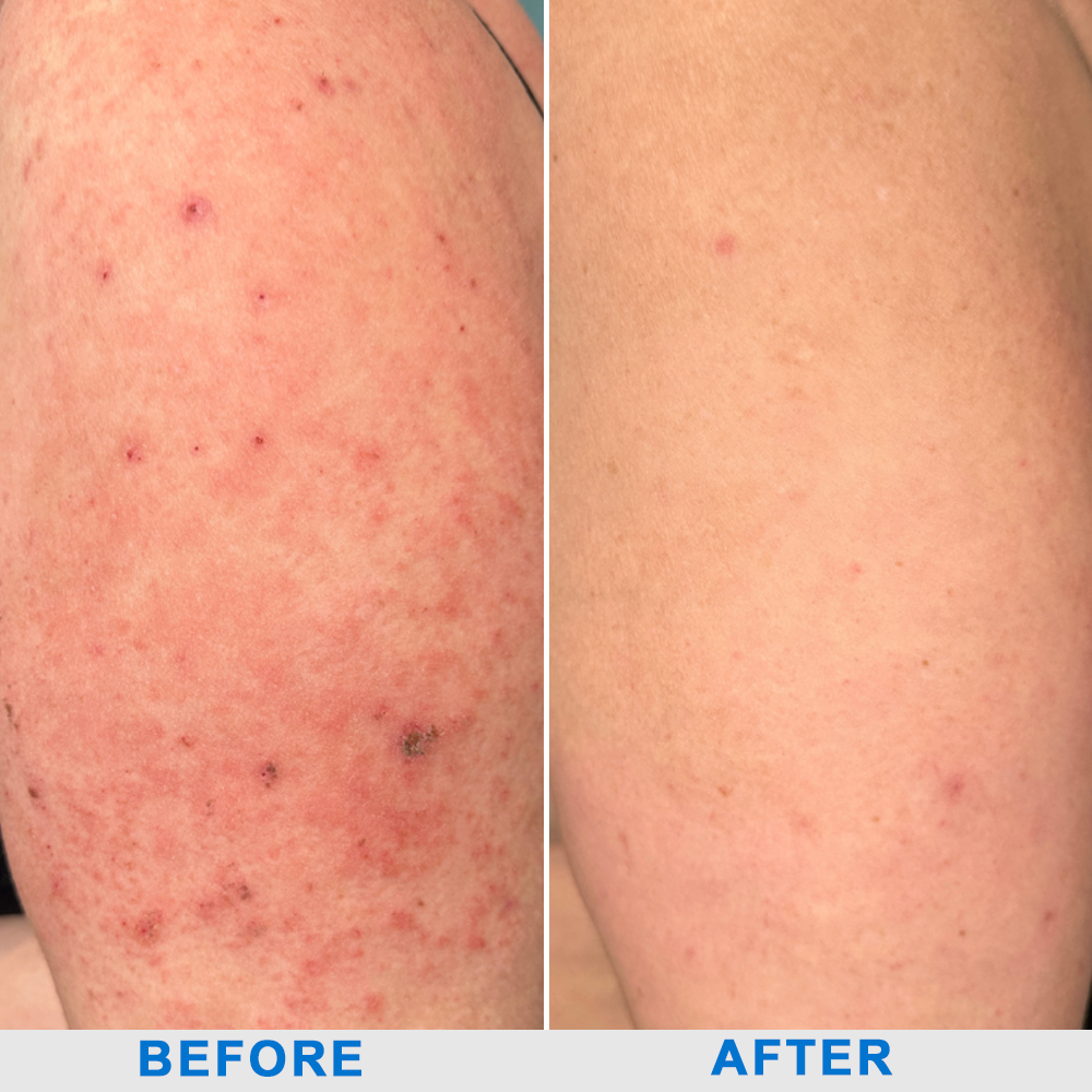 ✅NHS Approved: ODEIUN™ Skin Treatment Cream(Relieves eczema, dermatitis, psoriasis, skin allergies,  pigmentation, dry skin, and other common skin issues)