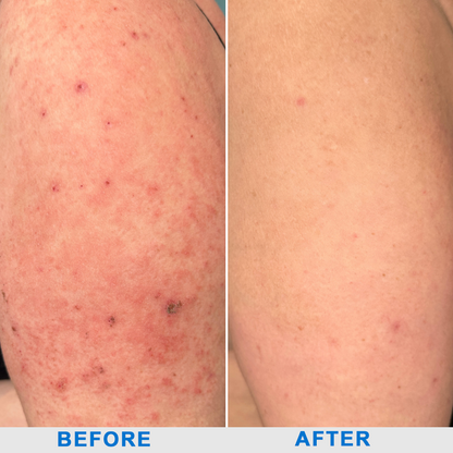✅NHS Approved: ODEIUN™ Skin Treatment Cream(Relieves eczema, dermatitis, psoriasis, skin allergies,  pigmentation, dry skin, and other common skin issues)