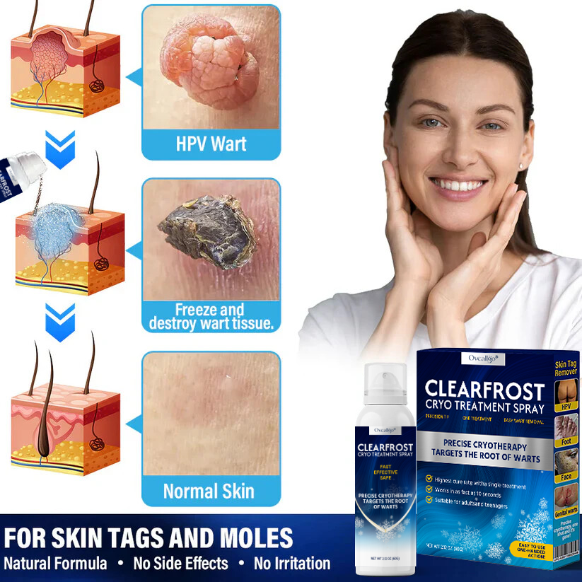Oveallgo® ClearFrost Cryo Treatment Spray Pro