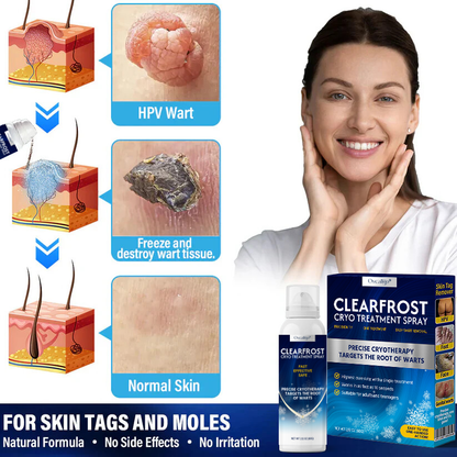 Oveallgo® ClearFrost Cryo Treatment Spray Pro