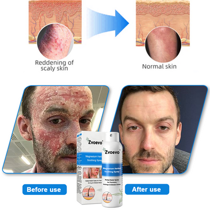 ✅ Official Store: Magnesium Herbal Psoriasis Spray ⚕️