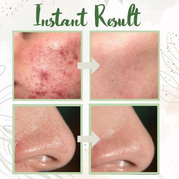 （🔥LAST DAY SALE-60% OFF + Includes a complimentary brush)Final Sale -Herbal Deep Cleansing Mask
