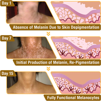 【Official Flagship Store】 Bee Venom Vitiligo Treatment Cream