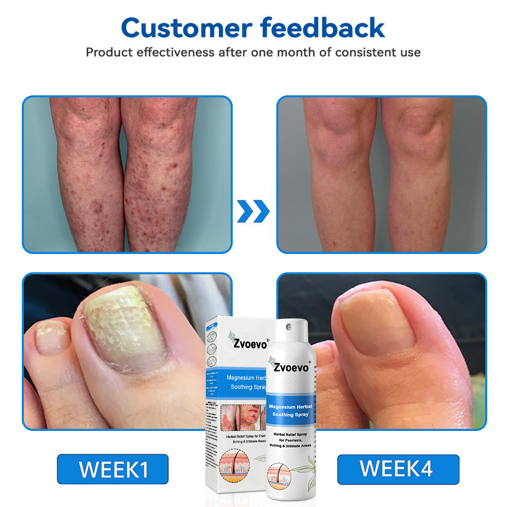 ✅ Official Store: Magnesium Herbal Psoriasis Spray ⚕️