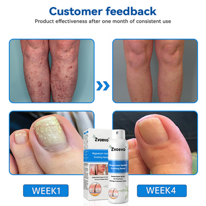 ✅ Official Store: Magnesium Herbal Psoriasis Spray ⚕️