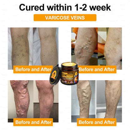 ✅Official Store: Bee-Venom Pain-Relief Bone Healing Cream✅( BOA Approved)(🔥𝑳𝒂𝒔𝒕 𝒅𝒂𝒚 𝒑𝒓𝒐𝒎𝒐𝒕𝒊𝒐𝒏 80% 𝒐𝒇𝒇)🍀