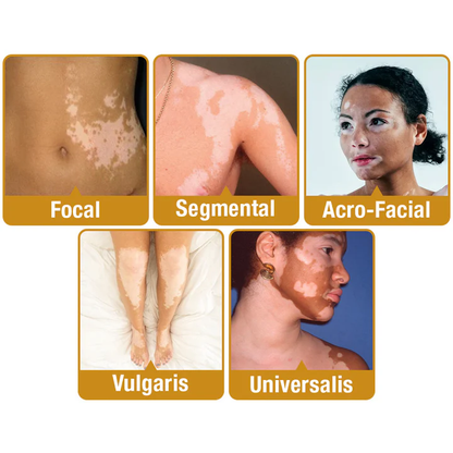 【Official Flagship Store】 Bee Venom Vitiligo Treatment Cream