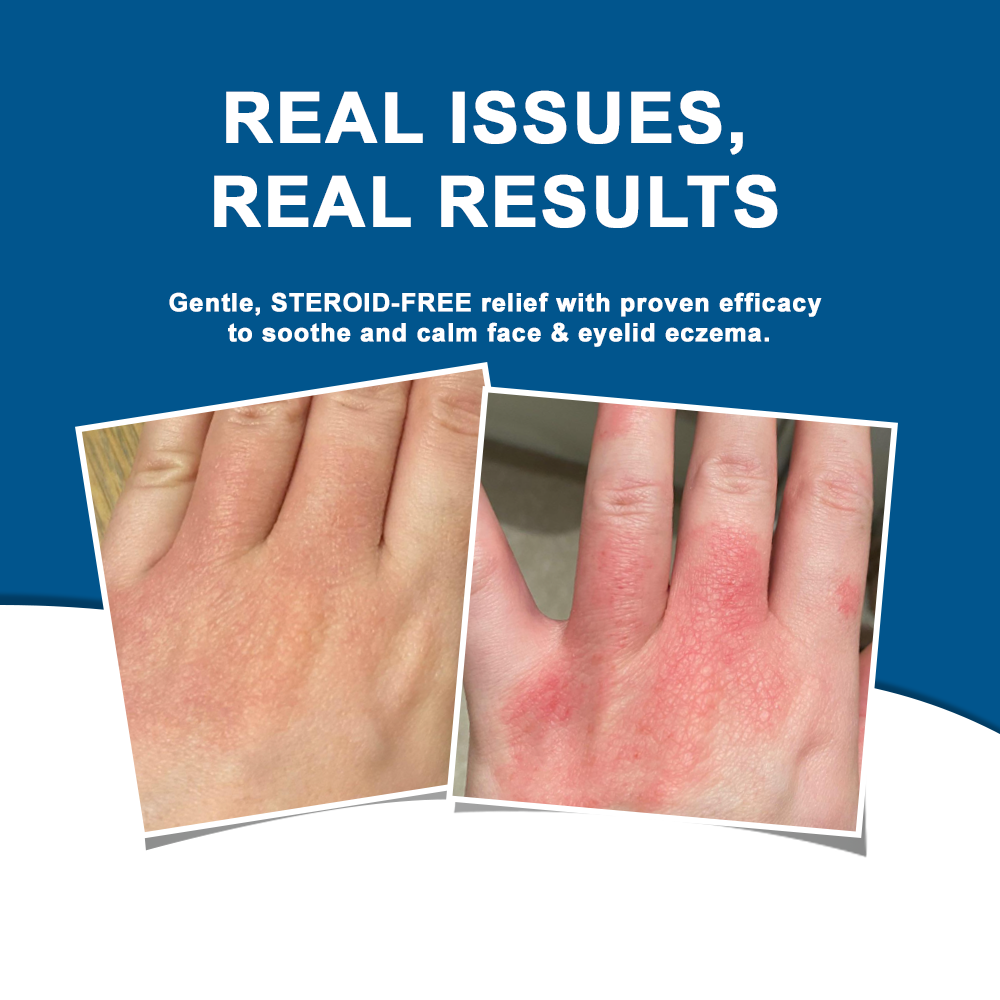 ✅NHS Approved: ODEIUN™ Skin Treatment Cream(Relieves eczema, dermatitis, psoriasis, skin allergies,  pigmentation, dry skin, and other common skin issues)