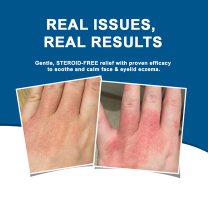 ✅NHS Approved: ODEIUN™ Skin Treatment Cream(Relieves eczema, dermatitis, psoriasis, skin allergies,  pigmentation, dry skin, and other common skin issues)