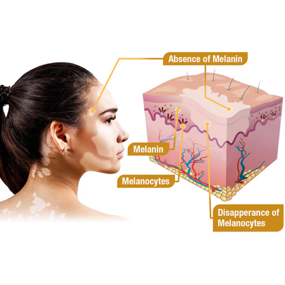【Official Flagship Store】 Bee Venom Vitiligo Treatment Cream