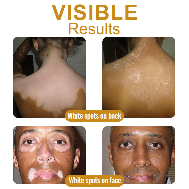 【Official Flagship Store】 Bee Venom Vitiligo Treatment Cream