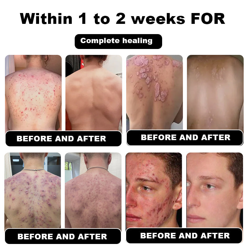 Psoriasis Cure Cream, relieves itching and restores smooth and youthful skin