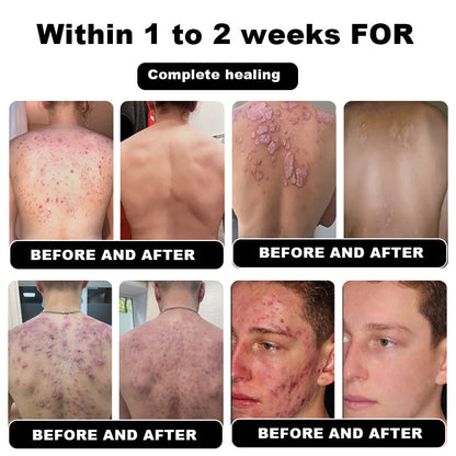 Psoriasis Cure Cream, relieves itching and restores smooth and youthful skin