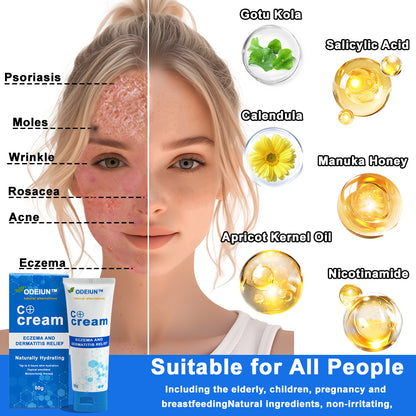 ✅NHS Approved: ODEIUN™ Skin Treatment Cream(Relieves eczema, dermatitis, psoriasis, skin allergies,  pigmentation, dry skin, and other common skin issues)