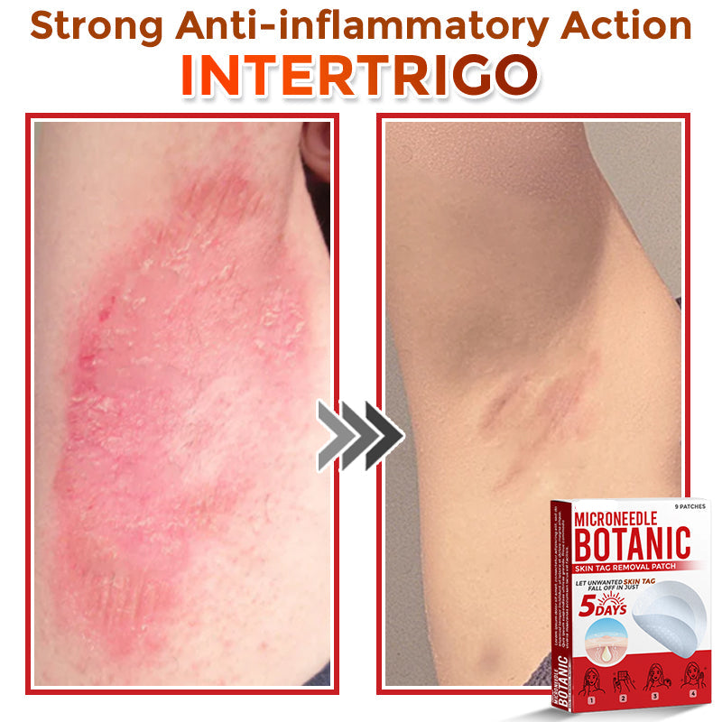 【Official Flagship Store】MicroNeedle Botanic Skin Tag Removal Patch|Made in the USA