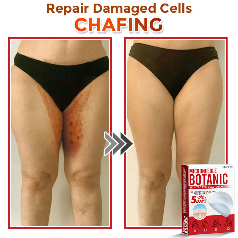 【Official Flagship Store】MicroNeedle Botanic Skin Tag Removal Patch|Made in the USA