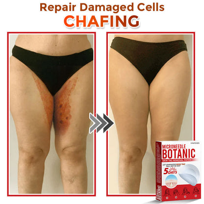 【Official Flagship Store】MicroNeedle Botanic Skin Tag Removal Patch|Made in the USA