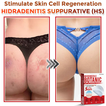 【Official Flagship Store】MicroNeedle Botanic Skin Tag Removal Patch|Made in the USA