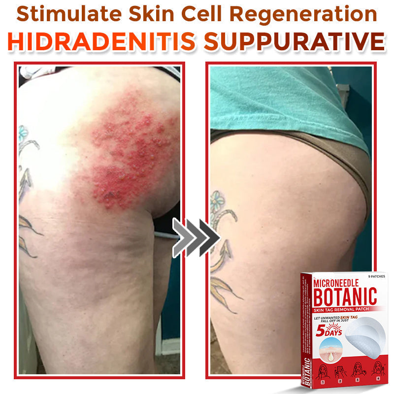 【Official Flagship Store】MicroNeedle Botanic Skin Tag Removal Patch|Made in the USA