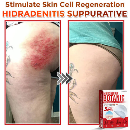 【Official Flagship Store】MicroNeedle Botanic Skin Tag Removal Patch|Made in the USA
