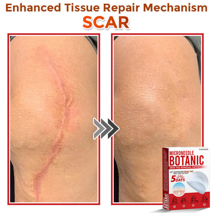 【Official Flagship Store】MicroNeedle Botanic Skin Tag Removal Patch|Made in the USA