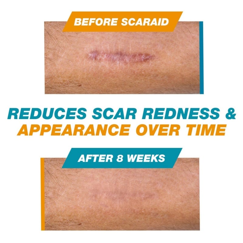 Skin Scar Solutions🛡️ 60%  Silicone Scar Stick