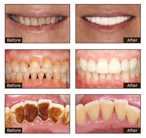 1🔥[Official Brand Store] ODALIT™ Niacinamide Intensive Whitening Toothpaste