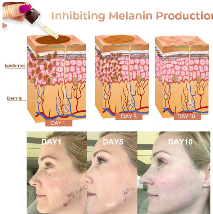 ✨Fast Dark Spot Remover-NESLEMY™ Melanin Correcting Facial Serum