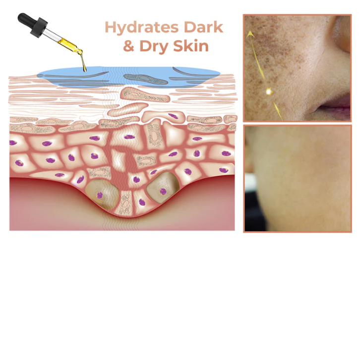 ✨Fast Dark Spot Remover-NESLEMY™ Melanin Correcting Facial Serum