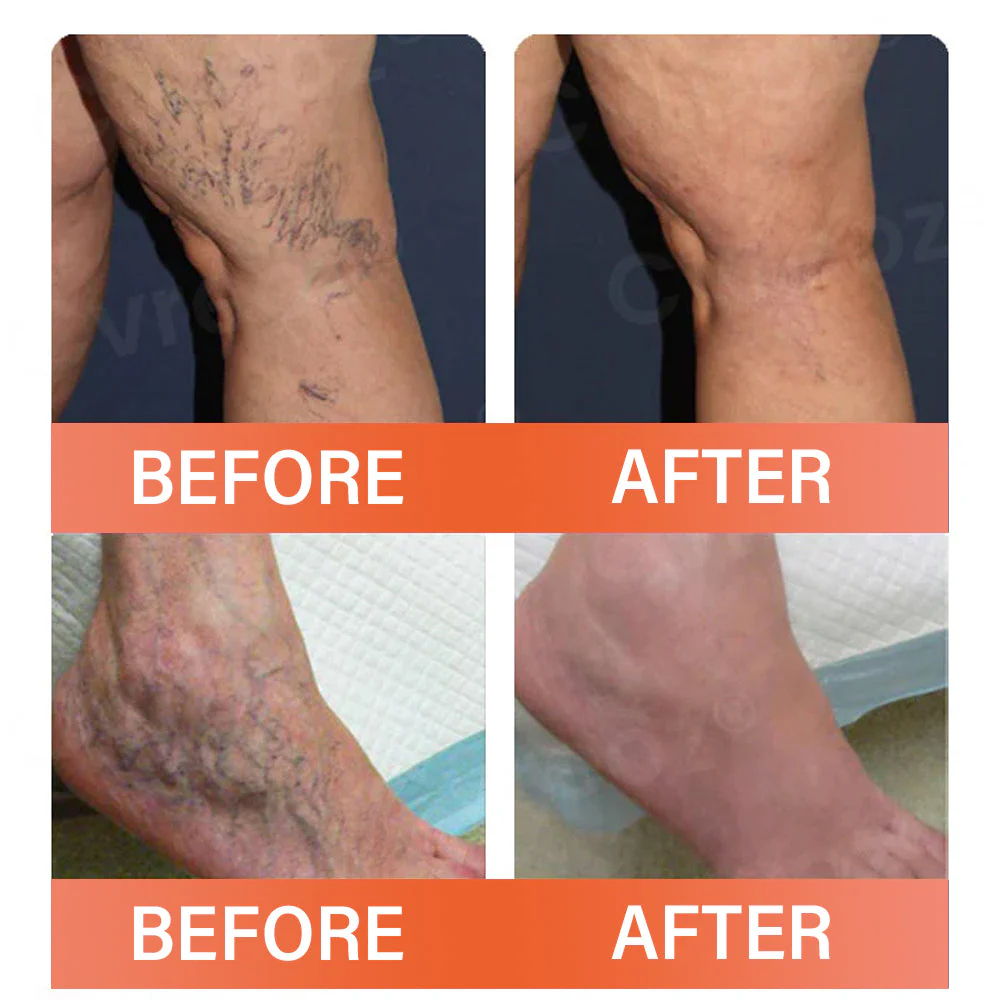 【Official Flagship Store】VeinEase Microneedle Therapy Patch