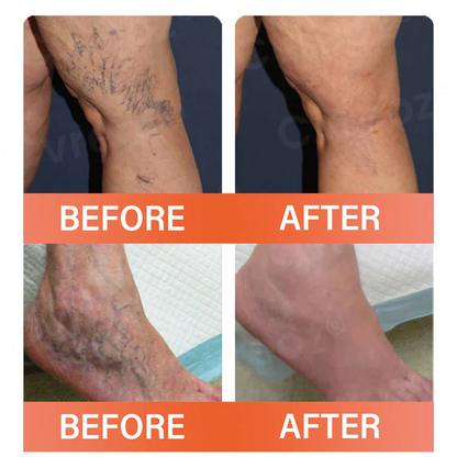 【Official Flagship Store】VeinEase Microneedle Therapy Patch