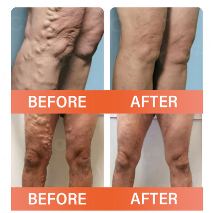 【Official Flagship Store】VeinEase Microneedle Therapy Patch